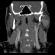 Warthin tumor, parotid gland: CT - Computed tomography